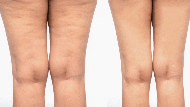 cellulite-treatment-nyc