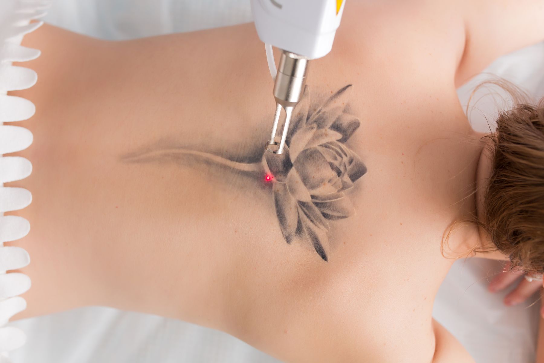 laser-tattoo-removal-nyc